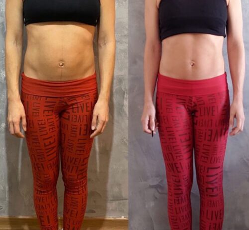 Antes e Depois de uma Reabilitação Abdominal: Fatores que Influenciam no Sucesso
