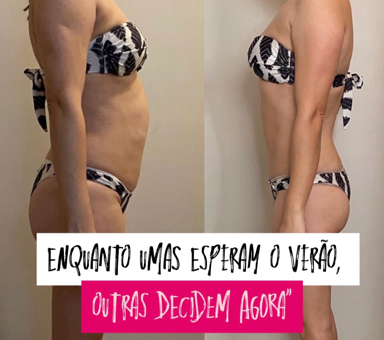 GlowMommy: o protocolo que prepara o abdômen das mamães para o verão com inteligência e sofisticação